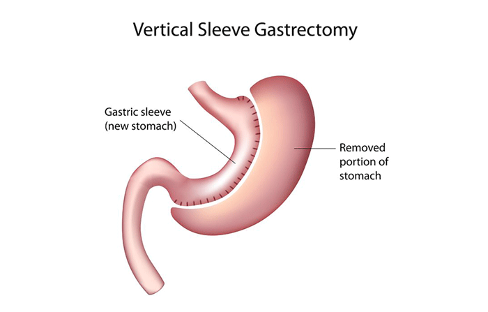 Vertical Gastric Sleeve